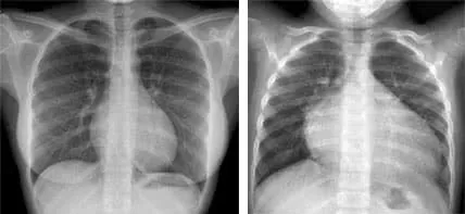 cardiomegalie