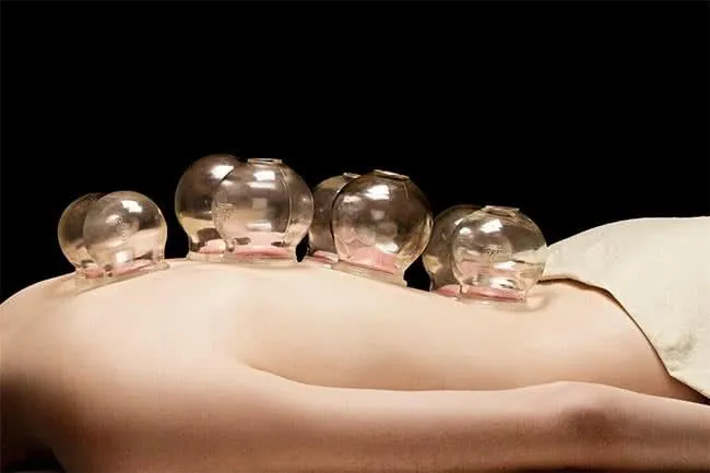 cupping-therapie